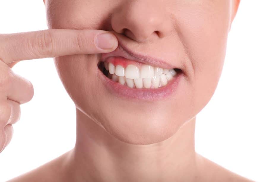 Early Signs of Gum Disease You Shouldn’t Ignore