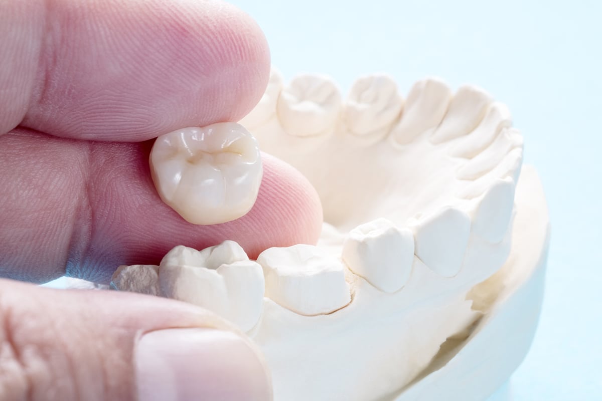 How Long Do Dental Crowns Last? Dentistry of Mendham NJ